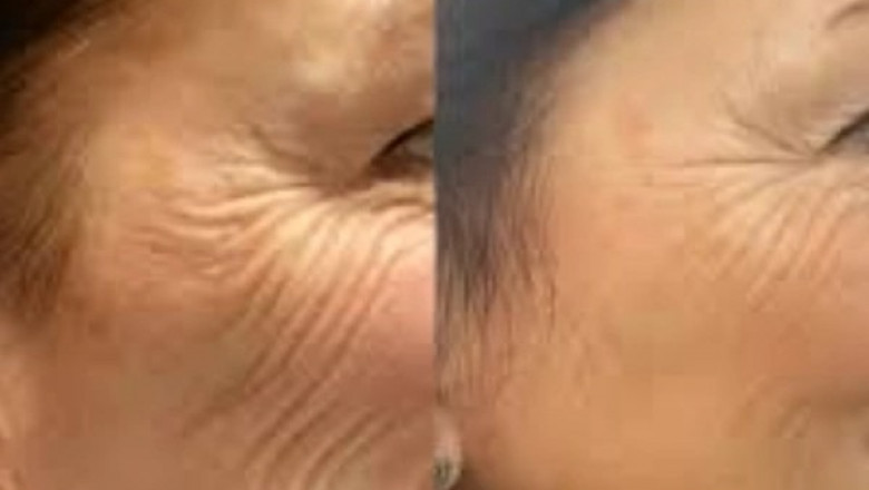 Rewire Aging Signs via Profhilo from Best Plastic Surgeons in dubai