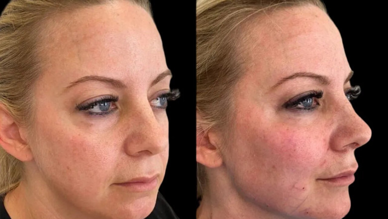 Cheek Fillers Treatment in Dubai: What Is the Best Age to Start?