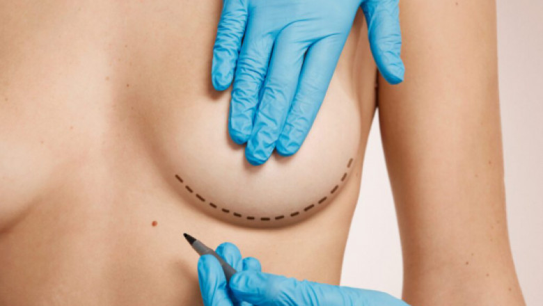 What Makes Breast Reduction Surgery in Istanbul a Popular Choice? Lifeline Turkey Shares Key Facts