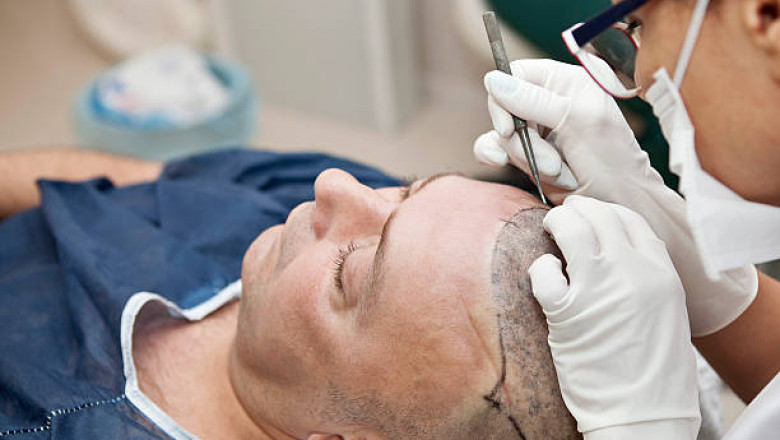 Hair Transplant Financing Options in Dubai: Making Your Procedure Affordable