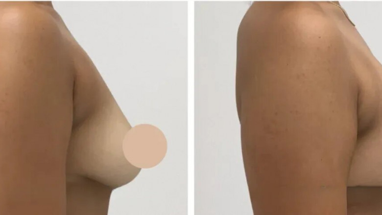 Exploring Breast Lift Results: What You Can Expect in Dubai
