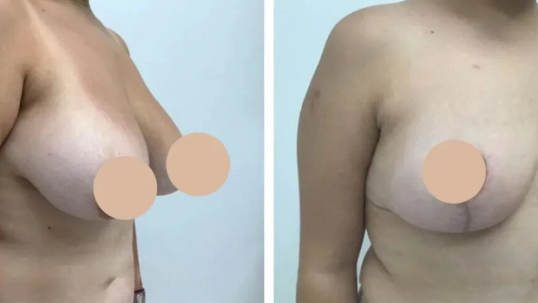 The Complete Breast Reduction Process in Dubai: What to Expect