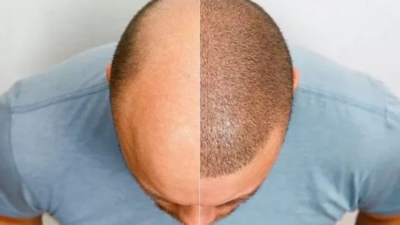 Ethical Considerations and Patient Selection for Hair Transplant Surgery in Dubai