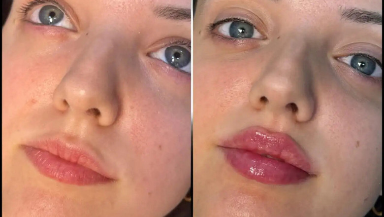 How to Boost Your Confidence with Fillers from the Best Plastic Surgeon in dubai