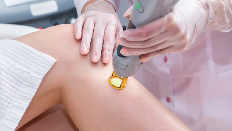 Laser Wart Removal: Safe, Fast, and Effective