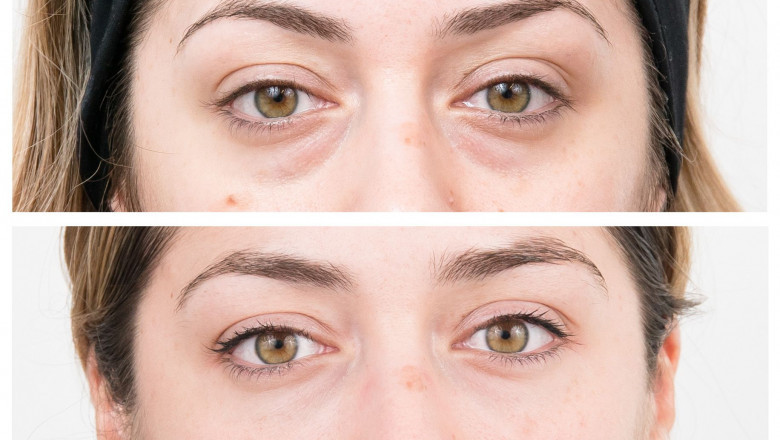Ethnic Considerations in Blepharoplasty: Adapting Surgical Approaches for Diverse Anatomies