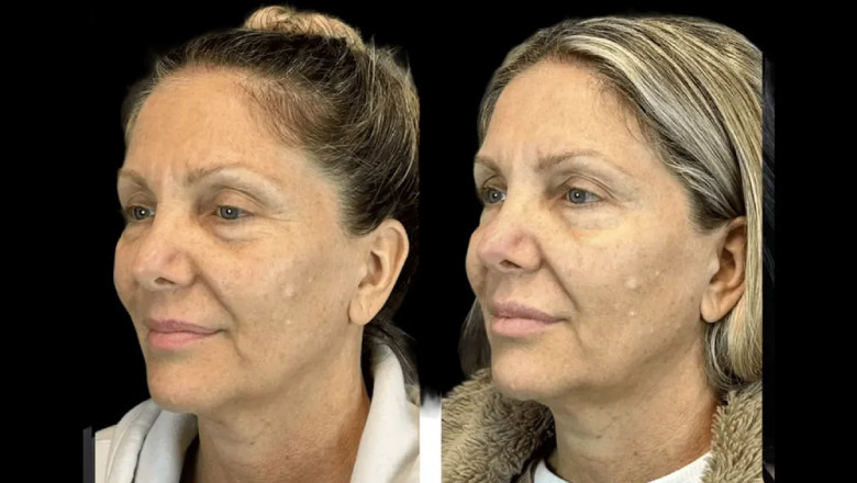 Is Botox Treatment in Dubai Safe? Here’s What Experts Say
