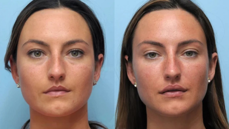 How Thread Lift Treatments in Dubai Can Transform Your Look