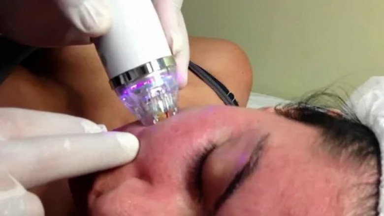 Safety considerations and potential side effects of Fractional RF Micro Needling treatments.