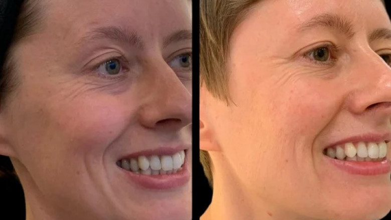 Why Profhilo Treatments in Dubai Are the Secret to Glowing Skin