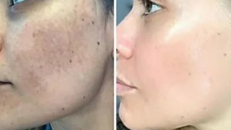 Real Patient Experiences and Before-and-After Photos of Cosmelan Peel Treatments in Dubai