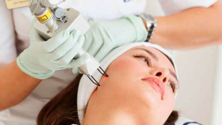 Can Fractional Laser Treat Sun Damage?
