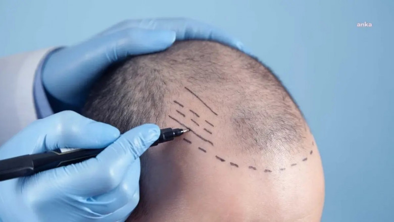 Hair Transplant Trends: What’s New in 2025