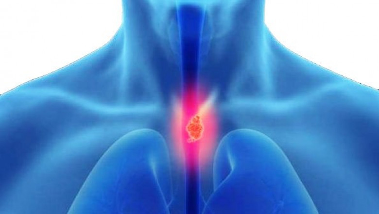 Laparoscopic Esophageal Surgery in Delhi: Precision Care for Complex Esophageal Disorders