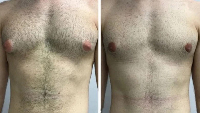 Qualities That Define the Best Gynecomastia Surgeon in Dubai