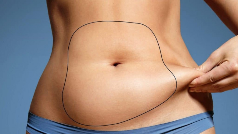 Liposuction 101 Essential Factors Uncovered by Best Liposuction Surgeons in Dubai