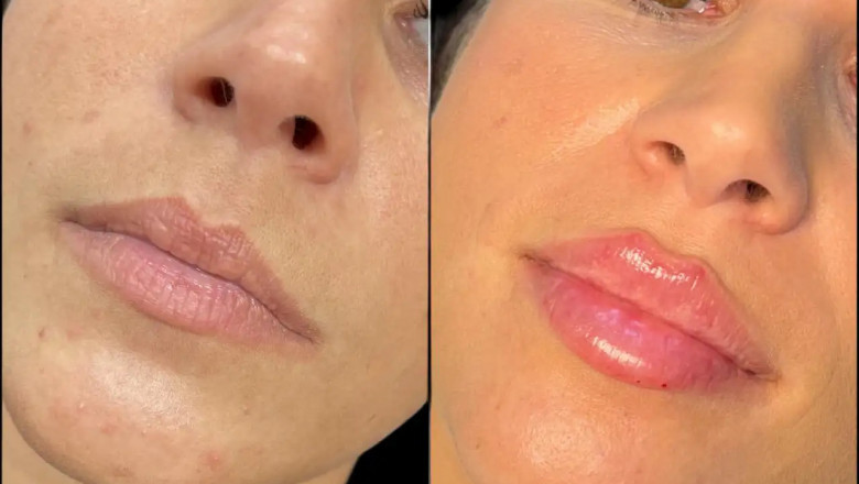 The History of Fillers in Dubai: How They Became Popular