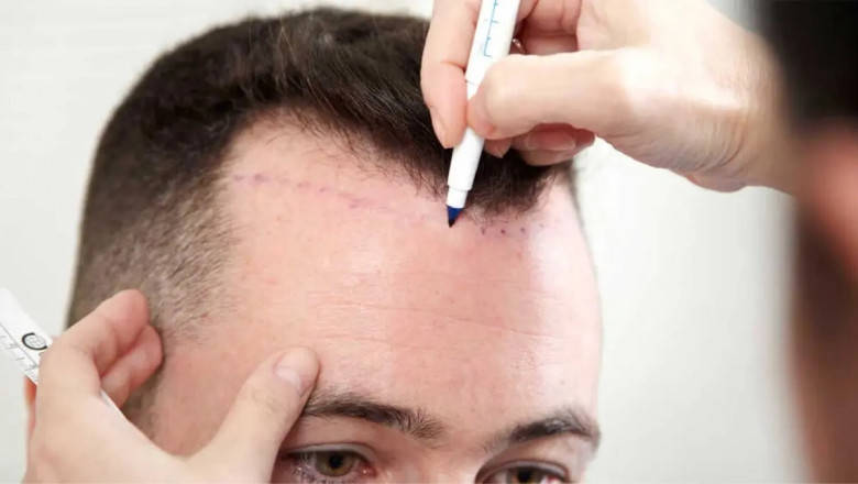 Beard and Eyebrow Hair Transplants Explained