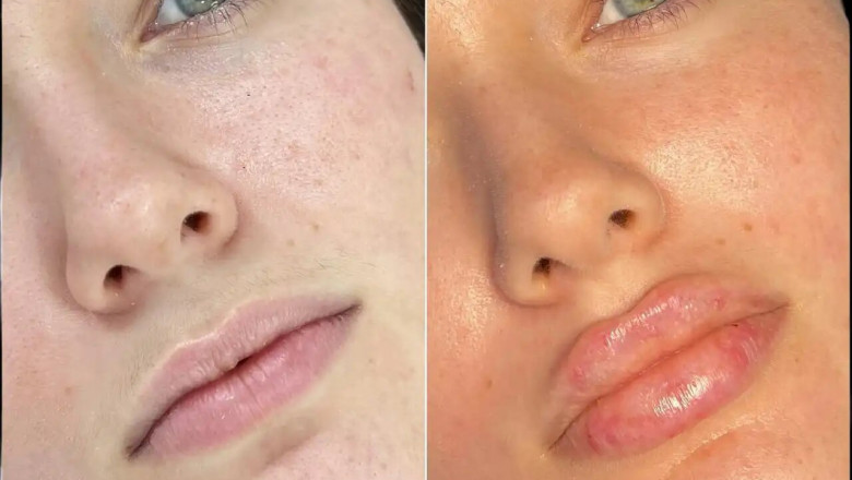 Why the Best Plastic Surgeons in dubai Should Be Your First Choice for Fillers