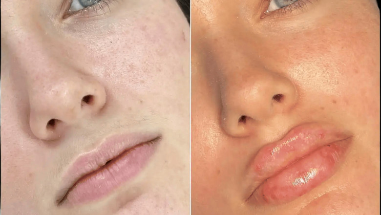 Best Plastic Surgeon in Dubai for Fillers: Quality You Can See