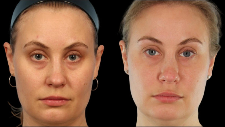 The Best Under Eye Fillers Treatment in Dubai for Sensitive Skin