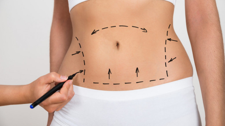 Expert Precision Radiant Results Liposuction in Dubai You Can Trust