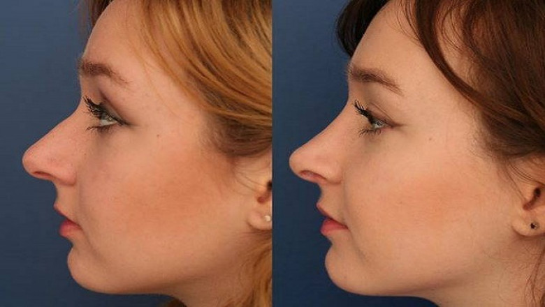 عملية تجميل الأنف في الرياض