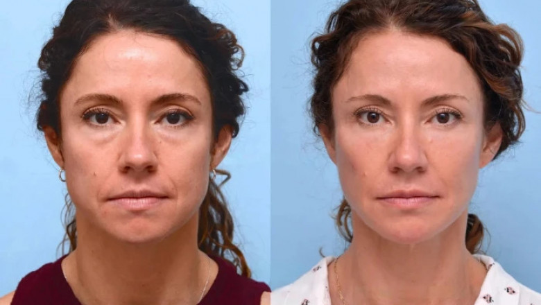 Why Thread Lift Is Trending: Insights from the Best Plastic Surgeons in Dubai