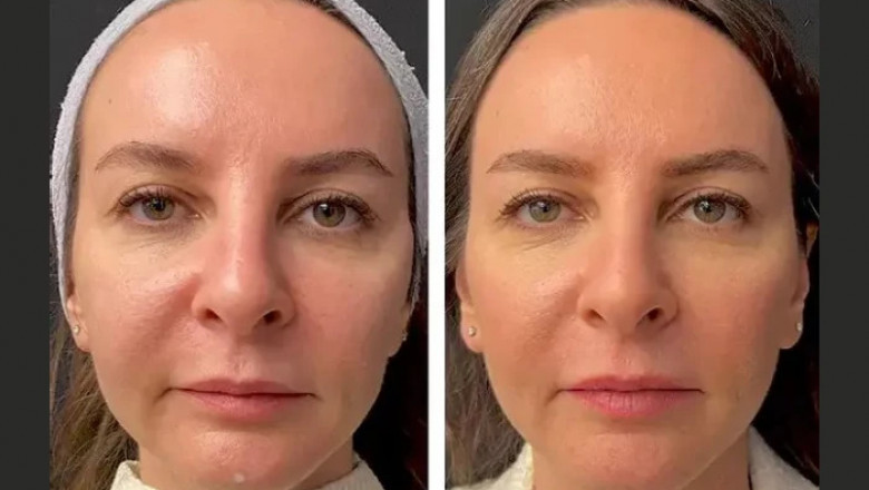 How the Best Plastic Surgeon in Dubai Performs Mesotherapy for Skin Rejuvenation
