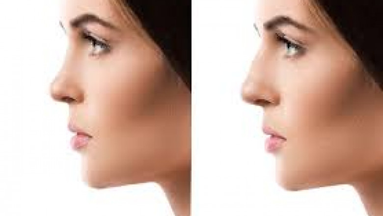 جراحة تجميل الأنف