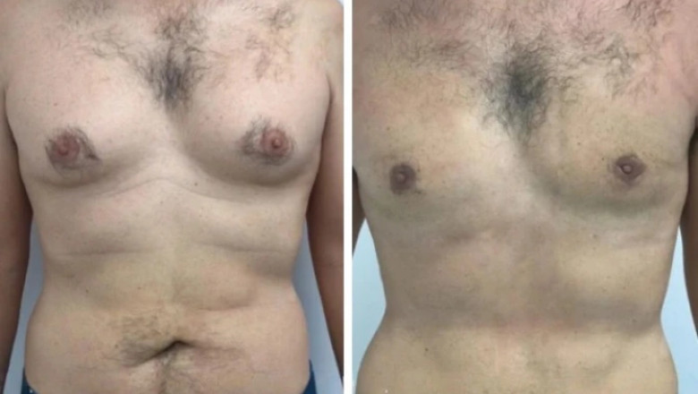 Best Gynecomastia Surgeons in dubai: Ensuring Minimal Scarring and Maximum Satisfaction