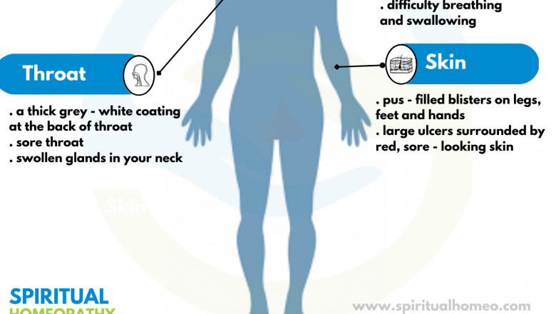 Holistic Diphtheria Treatment with Homeopathy in Hyderabad – Spiritual Homeopathy