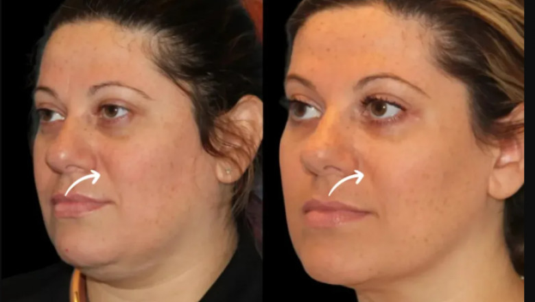 Visual Guide to Sculptra Fillers Process with the Best Plastic Surgeon in Dubai