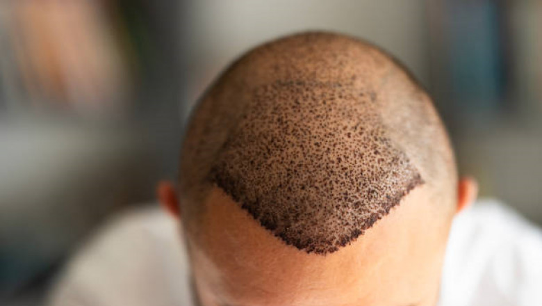 Hair Transplant in Riyadh: Permanent Hair Restoration