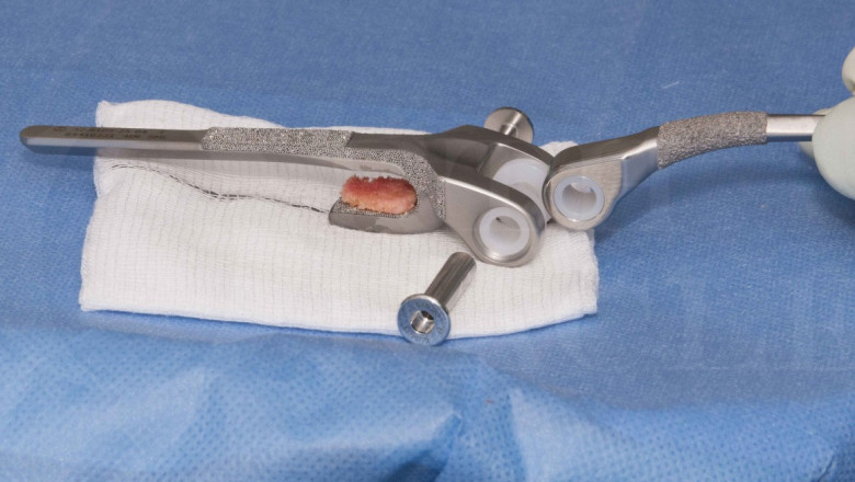 Modern Solutions for Elbow Joint Issues: Total Elbow Replacement Surgery in Delhi