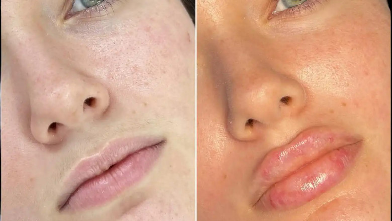Best Aesthetic Clinics in Dubai for Fillers for Youthful Skin