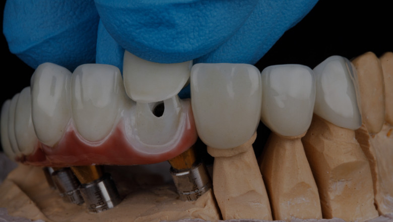 Crowns Near Me – Quality Restorative Dentistry at Delta Park Dental