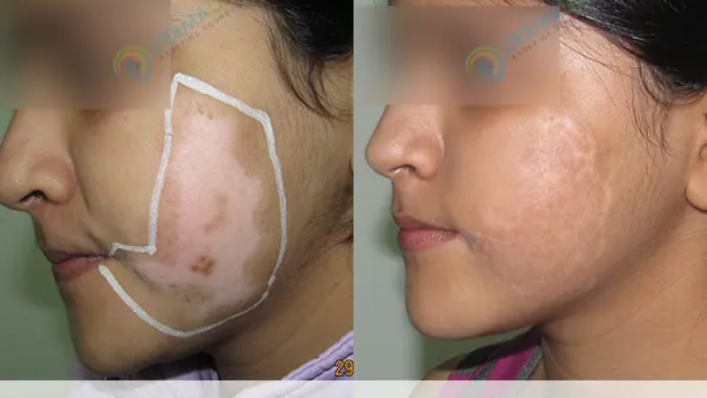 Successful Vitiligo Treatment in Delhi Renew Your Skin