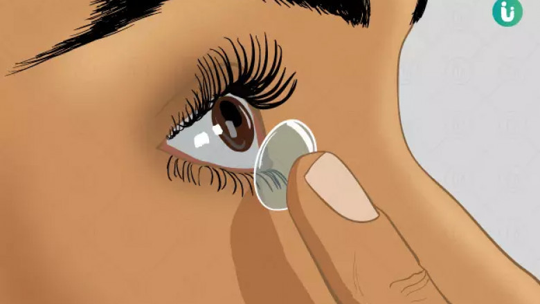 Global Therapeutic Contact Lenses Market Insights: Smart Lenses & Biosensor Integration