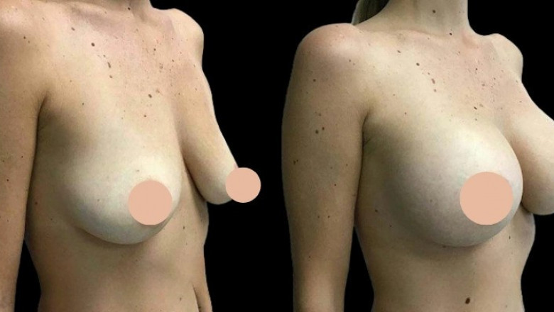 Breast Augmentation in Dubai Is It Right for You Exploring Common Concerns