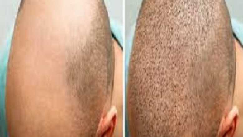تقنية DHI في زراعة الشعر: الخيار الأحدث والأدق في زراعة الشعر في الرياض