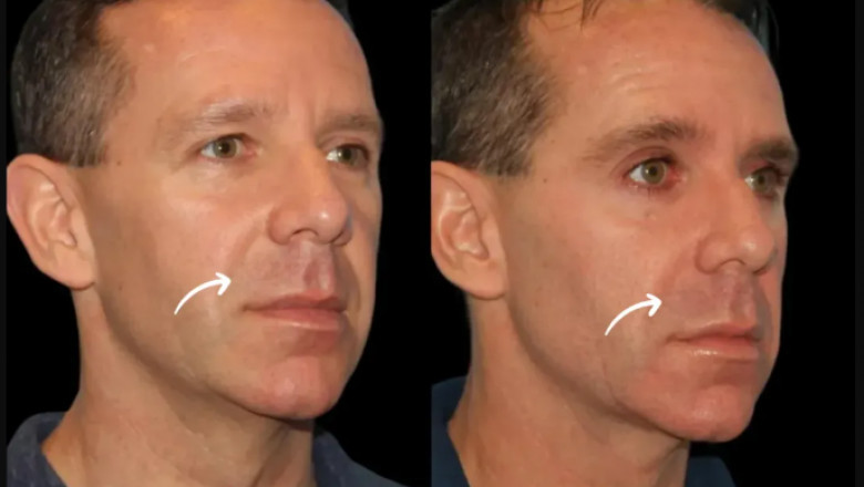 What Sets Apart the Best Plastic Surgeon in Dubai’s Sculptra Fillers Service?