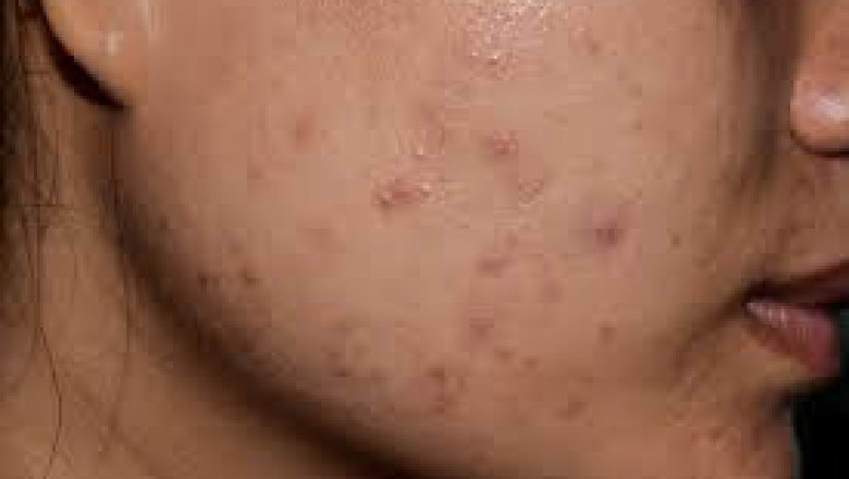 How Soon After Scar Treatment Can I Exercise?