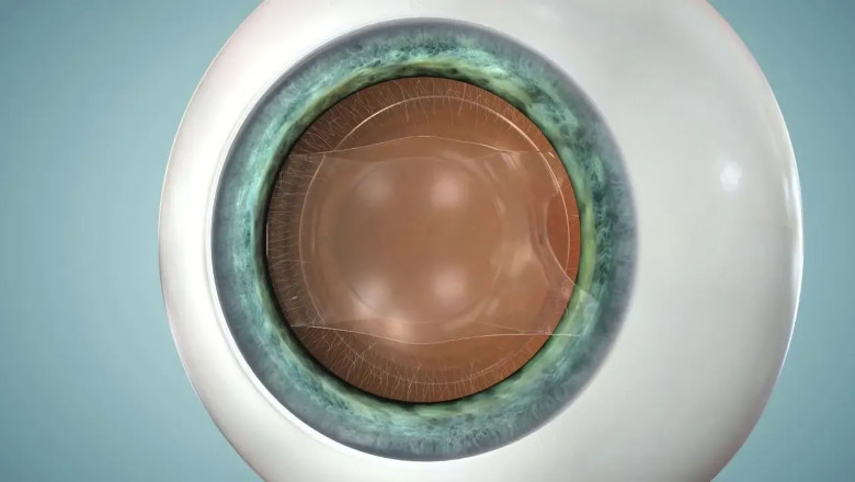 Types of Corneal Transplants: Which One Is Right for You?