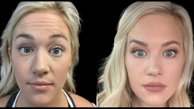 What to Expect in Your First Botox Treatment in Dubai: A Step-by-Step Guide