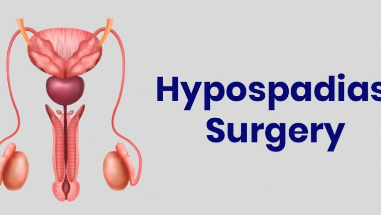 Understanding Hypospadias Surgery and Its Complications: A Guide for Parents
