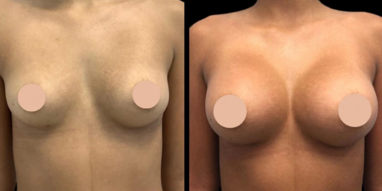 Affordable Breast Augmentation Surgery in Dubai | Top Surgeons on a Budget