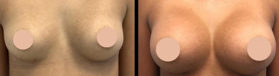 Breast Augmentation Surgeon