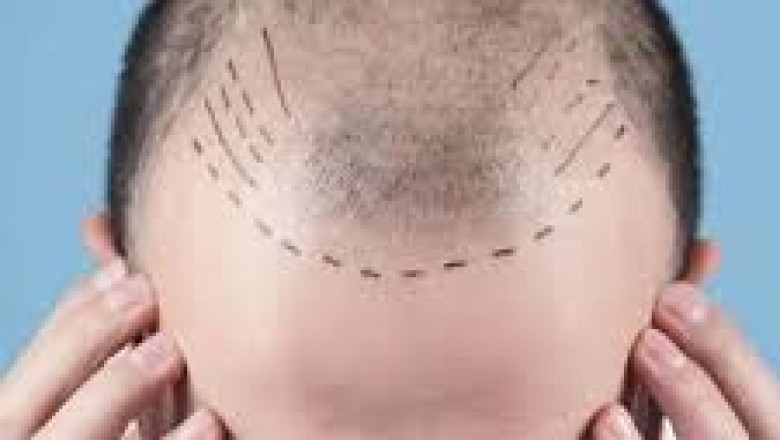 Hair Transplant in Riyadh