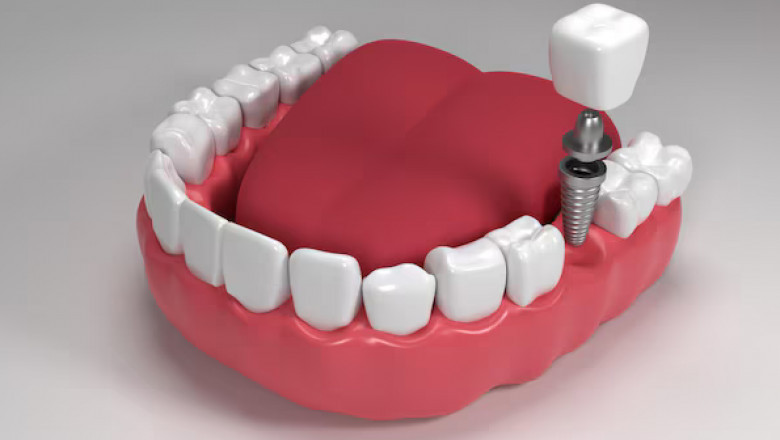 Implant Dentist - The Benefits of Dental Implants